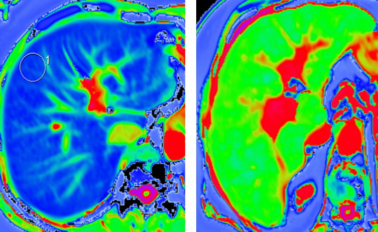 Examples of MRI scans for liver scarring evaluation showing (a) mild scarring and (b) severe scarring