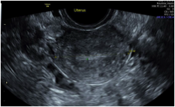 Ultrasound image