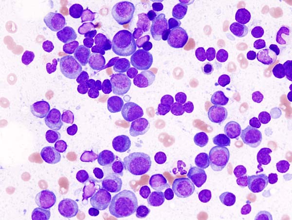 Histopathology image of multiple myeloma 