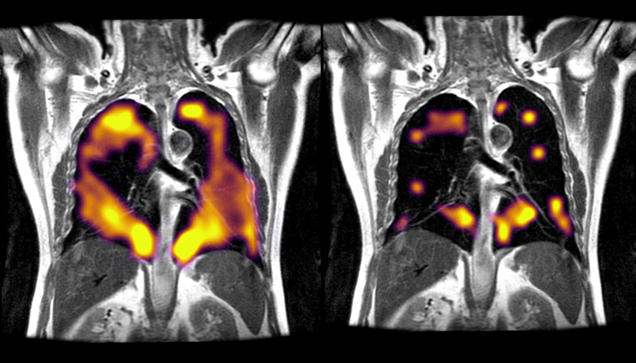 Lungs after covid