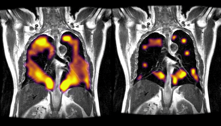 Hyperpolarised xenon MRI scan showing lung damage in COVID-19 patient 