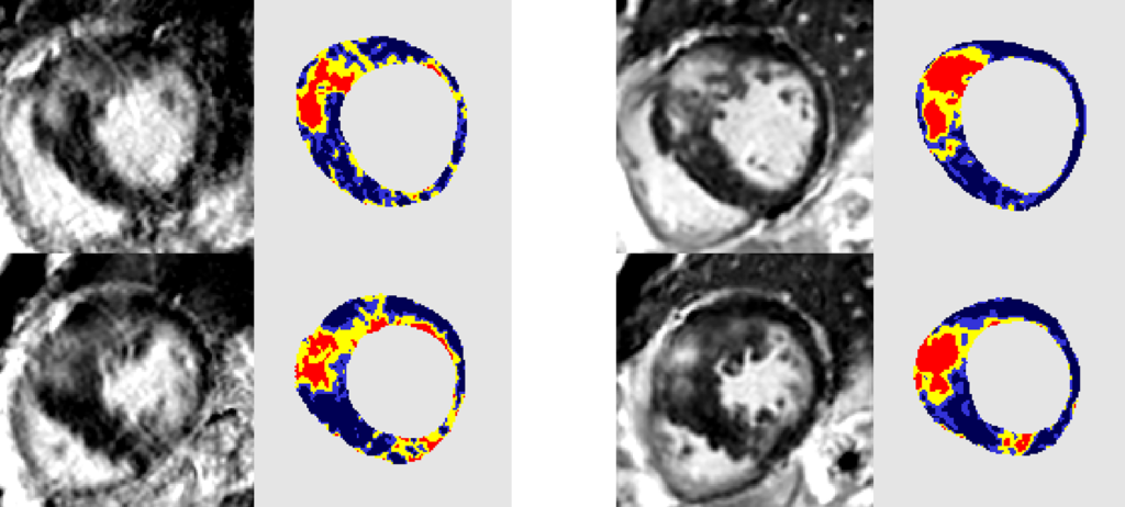 Medical images comparing late gadolinium enhancement scans with AI virtual native enhancement.