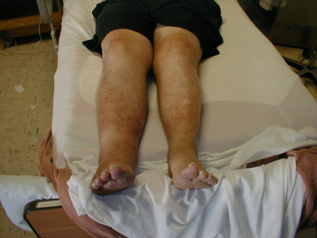 Legs of patient with deep vein thrombosis
