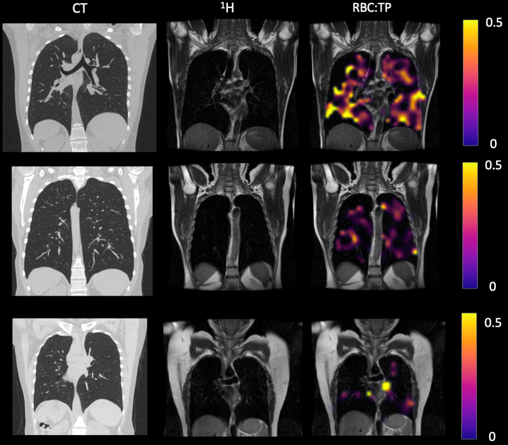 Images comparing a regular CT scan with those using xenon MRI scans