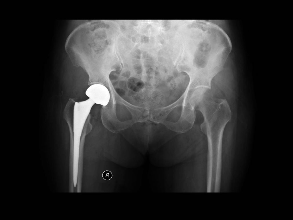 X-ray image showing hip replacement