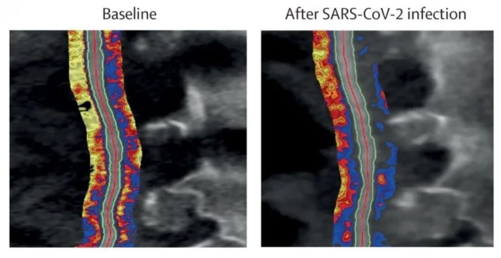 medical images showing vascular inflammation after SARS-Cov-2 infection