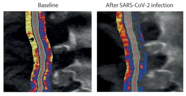 Study Develops Radiotranscriptomic AI Analysis To Enable Virtual Heart ...