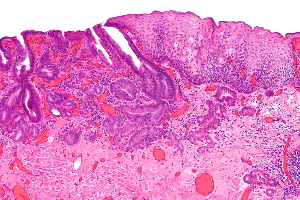Microscopic image of oesophageal adenocarcinoma