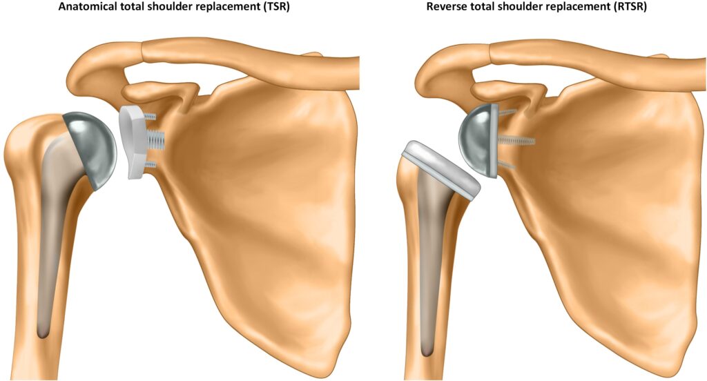 Illustration of the two shoulder replacement procedures