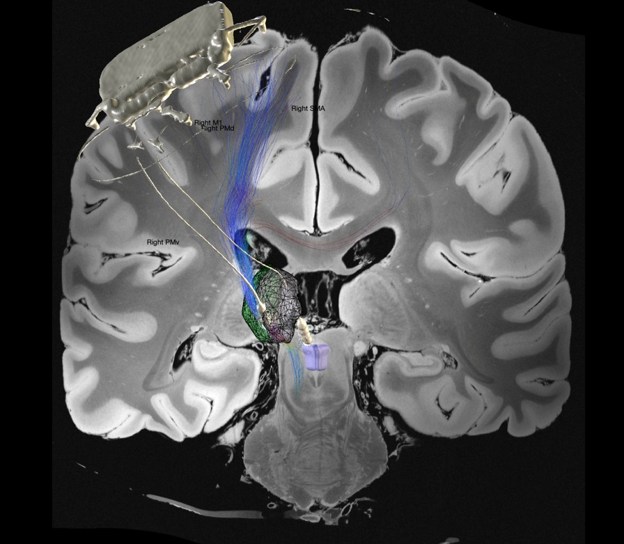 DyNeuMo EPIONE implant leads in PAG and Thalamus with tracts cropped