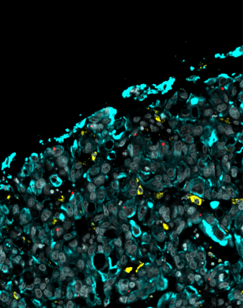 microscopic image of cancerous tissue