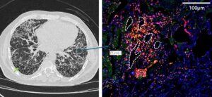 Lung fibrosis