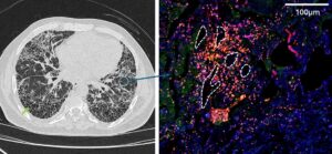 Lung fibrosis 2