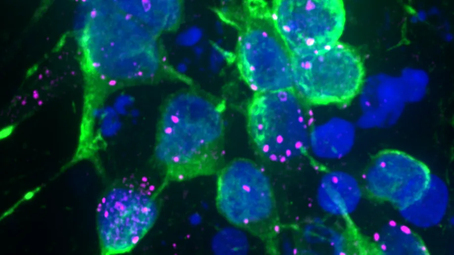 microscopic image of brain cells affected by clumps of the protein alpha-synuclein