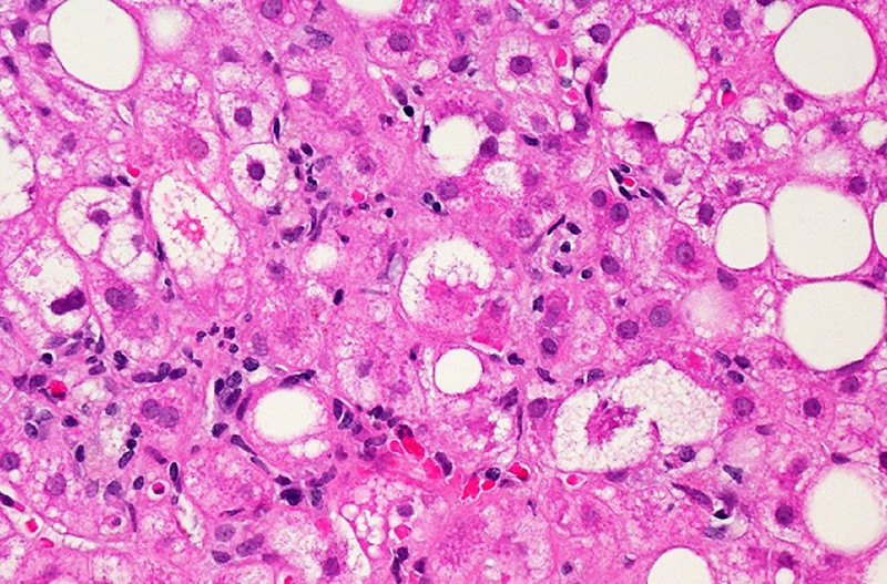 microscopic image showing white patches representing fat build-up on a pink background (liver cells)