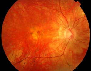 The back of the right eye from a patient with X linked retiniis pigmentosa